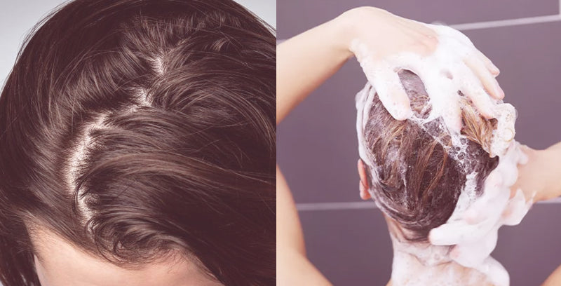 Greasy hair: a short guide to prevent and fix it